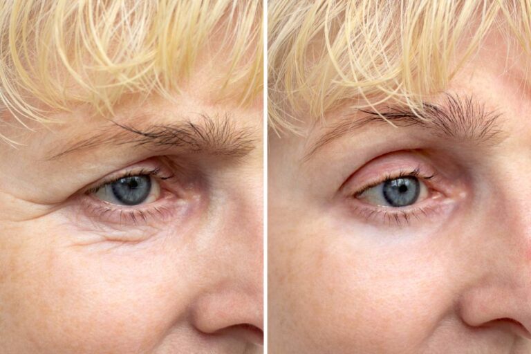 How to Get Rid of Under Eye Wrinkles